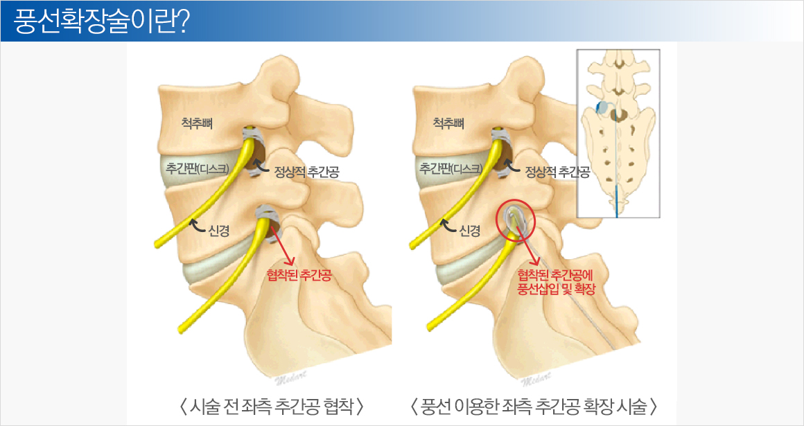 풍선확장술이란? / 시술 전 좌측 추간공 협착. 풍선 이용한 좌측 추간공 확장 시술