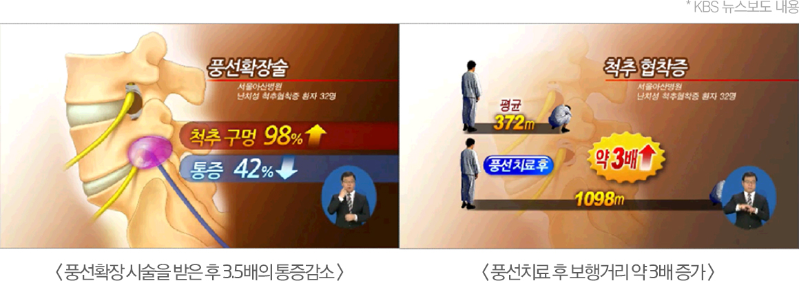 뉴스보도 자료 - 풍선확장 시술을 받은 후 3.5배의 통증감소 / 풍선치료 후 보행거리 약 3배 증가